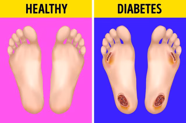 5 dau hieu bat thuong o ban chan “to” ban mac benh tieu duong