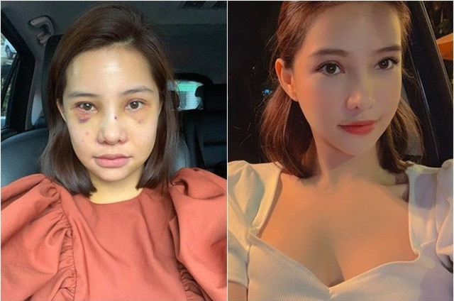 Cô cho biết, các phẫu thuật chỉnh sửa được thực hiện ở một Bệnh viện thẩm mỹ ở Hàn Quốc bao gồm: Hạ gò má, nâng mũi, trượt cằm, căng chỉ, cấy mỡ tự thân...Hình ảnh sau phẫu thuật 7 ngày (trái) và nhan sắc hiện tại.