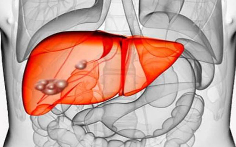 Nước tiểu đậm màu hơn: Khi thấy màu nước tiểu đậm hơn nhiều so với bình thường và nhất là khi bạn thấy chất bài tiết có màu trắng - điều này có thể là dấu hiệu cho thấy bạn đang bị bệnh gan.