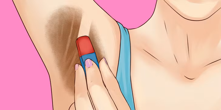 Nách bị thâm là một vấn đề rất nhiều bạn gái gặp phải, đặc biệt là phụ nữ sau sinh. Sau đây là những cách trị thâm nách bằng phương pháp tự nhiên vô cùng an toàn và hiệu quả do trang tin Brighside giới thiệu.