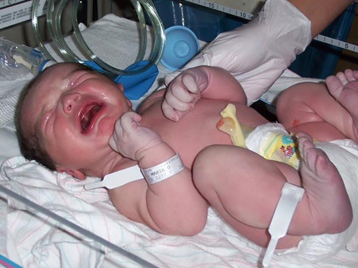 Dị tật bẩm sim: Thiếu vitamin K khi mang thai sẽ ảnh hưởng trực tiếp đến đứa trẻ. Các khuyết tật bẩm sinh có thể là xương không phát triển, mặt, mũi, hoặc ngón tay dị tật, khiếm khuyết ống thần kinh, suy dinh dưỡng, các vấn đề về tim...