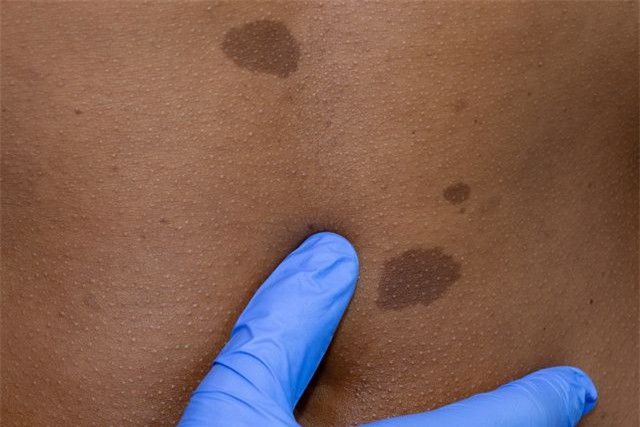 Nốt ruồi hoặc tổn thương mới: Những dấu hiệu bất thường trên da này có thể là dấu hiệu của ung thư da bao gồm vết loét không liền và nốt ruồi mới xuất hiện muộn. Bệnh nhân nên đi khám bác sĩ da liễu nếu nhận thấy bất kỳ dấu vết nào gây lo lắng trên cơ thể để được đánh giá kịp thời.