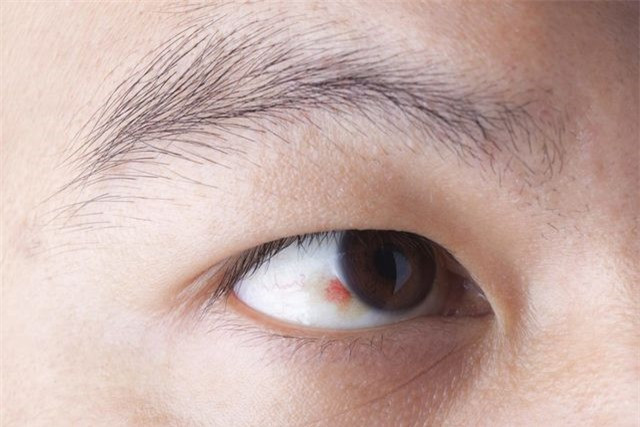 Những chấm chảy máu tái diễn trong mắt: Mặc dù xuất huyết dưới kết mạc – vỡ mạch máu trong mắt - có thể đáng sợ khi nhìn thấy, nhưng nó thường là một tình trạng vô hại sẽ hết trong vòng hai tuần hoặc hơn. Tuy nhiên, xuất huyết tái diễn hay gặp ở những người bị huyết áp cao hoặc đái tháo đường, theo Hội Tim Mỹ.