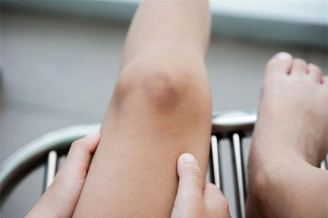 Bầm tím nhiều, không rõ nguyên nhân: Mặc dù vết bầm tím có thể xảy ra do giảm mỡ tự nhiên, thuốc, hoặc thậm chí là dùng corticoid tại chỗ, những lý do khác của bầm tím quá mức có thể đáng lo ngại. Theo Trung tâm điều trị ung thư Mỹ, vết bầm tím không thể giải thích được có thể là dấu hiệu sớm của bệnh bạch cầu.