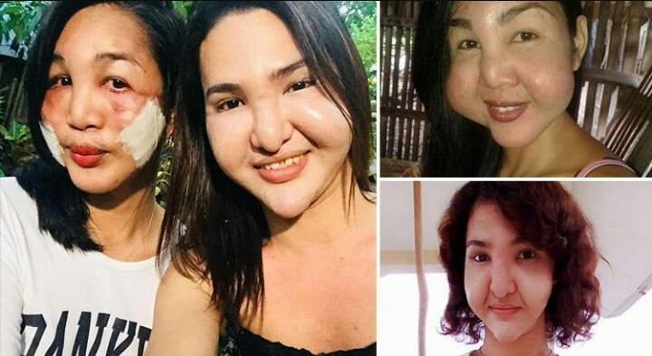 Tham hoa tham my khien cap ban than nguoi Phillippines bien dang khuon mat