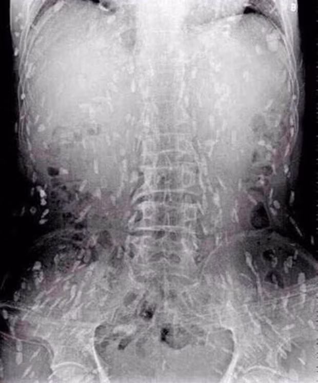 Ron nguoi nhung ca san luc nhuc trong co the vi thich an do tai song-Hinh-4