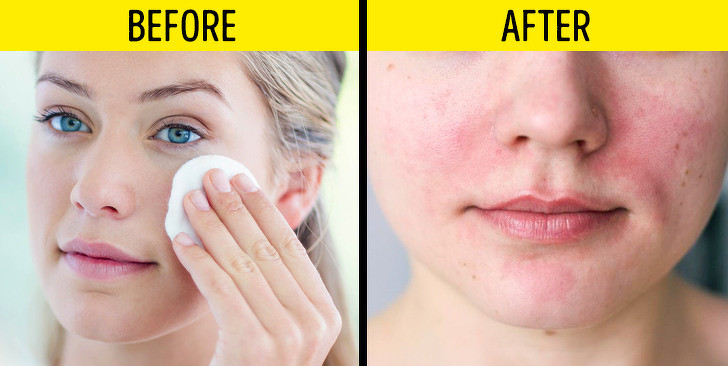 Không rửa mặt sau khi dùng micellar water: Micellar water (nước tẩy trang có chứa tinh thể dầu) là một sản phẩm tẩy trang quen thuộc. Nó giúp thu thập bụi bẩn trên da và chỉ được làm sạch hoàn toàn sau khi rửa mặt với nước. Nếu bạn bỏ qua bước này, làn da sẽ như được bao phủ bởi một lớp xà phòng, tích tụ bụi bẩn ngày một nhiều gây bít tắc lỗ chân lông, khiến da bị viêm, nổi mụn.