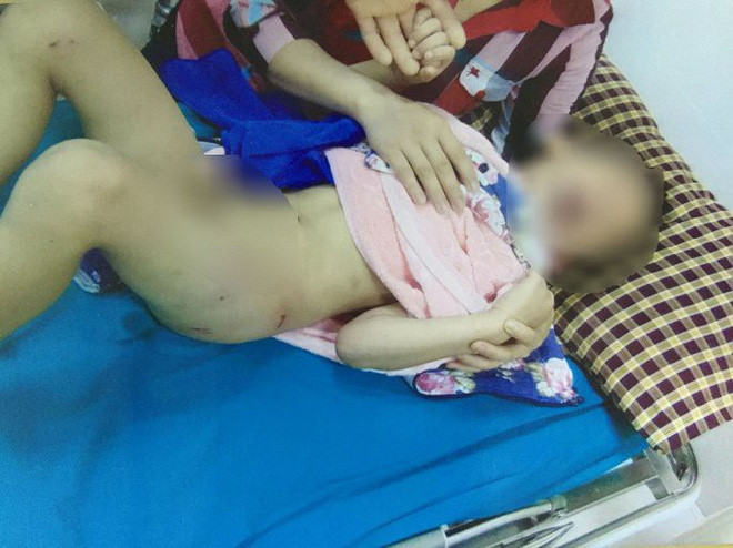 Cũng trong tháng 7 năm ngoái, Bệnh viện Đa khoa Hùng Vương (Phú Thọ) đã tiếp nhận một bệnh nhi tên là N.T.Đ 6 tuổi, sống tại Đoan Hùng, Phú Thọ. Cháu bé bị chó cắn nhập viện trong tình trạng hoảng loạn, phần đùi, mông có nhiều vết thương hở.