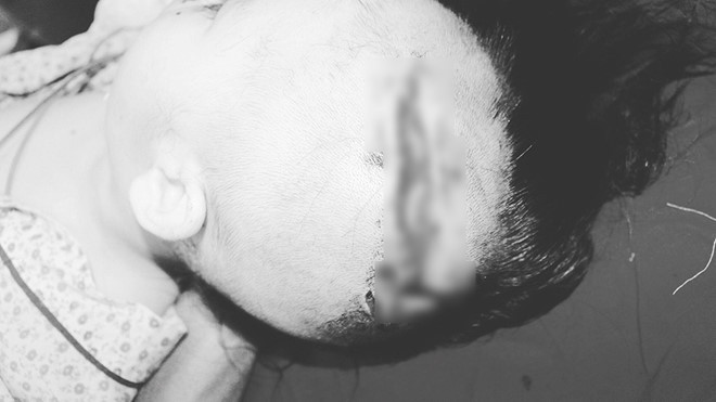 Ngày 16/8, Bệnh viện Xanh Pôn (Hà Nội) cho biết vừa điều trị cho một bệnh nhi 2 tuổi ở Hà Nội bị chó của gia đình người thân tấn công khiến vùng đầu, mặt bị thương nghiêm trọng. Nạn nhân nhập viện với nhiều vết rách chằng chéo vùng hàm mặt (mi dưới bên trái, gò má, môi). Đặc biệt là vết thương nghiêm trọng dài 15 cm ở vùng đầu, làm lộ xương sọ, chảy nhiều máu.