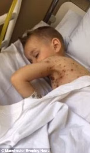 Bé Lewis sau đó phục hồi và chỉ còn những vết sẹo do nốt thủy đậu để lại.