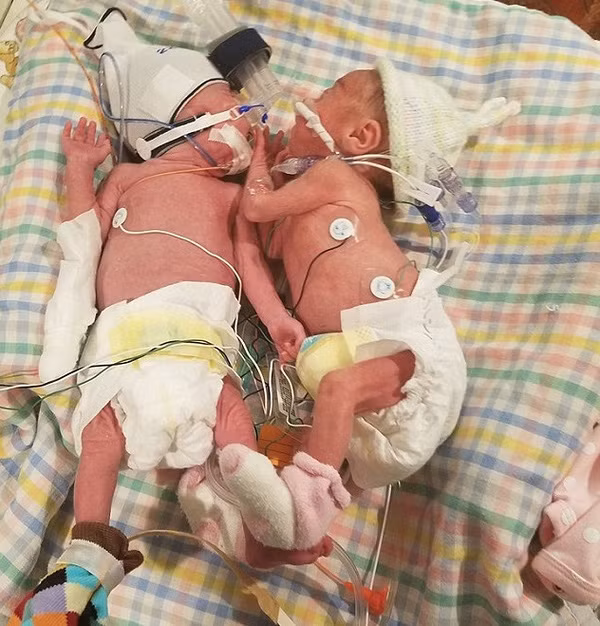 Một cặp song sinh ở Mỹ chào đời cách nhau 38 ngày tuổi. Kristen, mẹ của cặp song sinh cho biết, giai đoạn đầu của thời kỳ mang thai diễn ra rất suôn sẻ. Sang tuần thứ 22, cô cảm thấy cơn co thắt lúc đi lễ tại nhà thờ, bị vỡ ối và được cấp cứu vào bệnh viện. Các bác sĩ đã giúp cô duy trì thai kỳ thêm 2 tuần nữa và em bé đầu tiên được ra đời ở tuần thai thứ 24. Đó là một bé trai tên là Micah. 