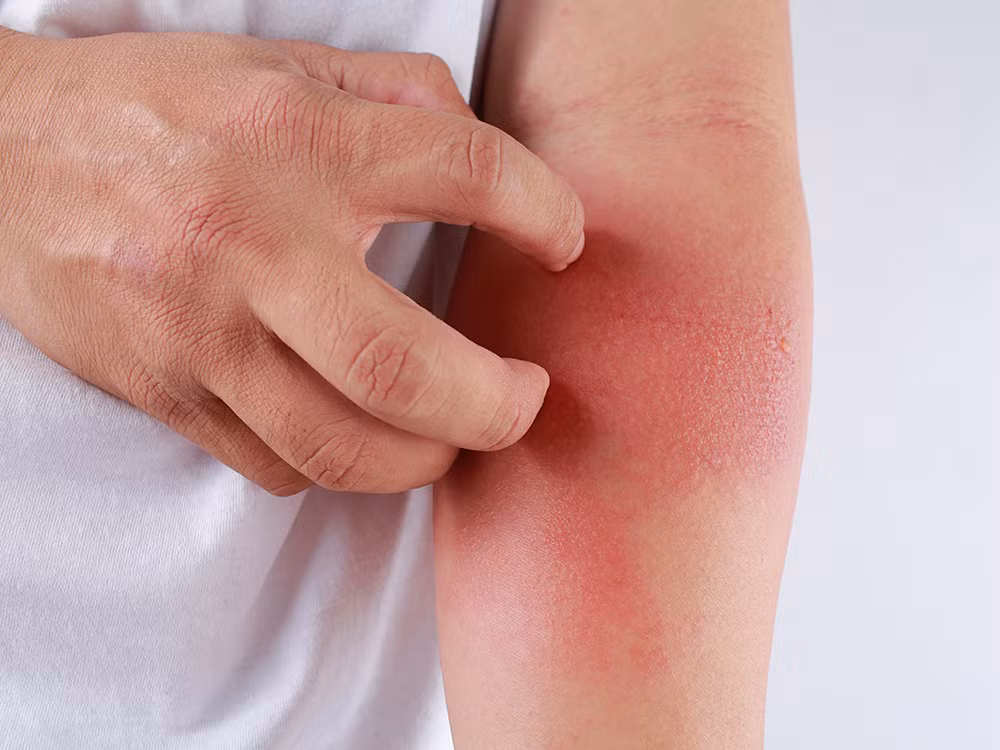 Để biết mình có bị dị ứng hay không mọi người có thể ăn thử một lượng nhỏ, nếu sau khi ăn không có hiện tượng gì bất thường thì có thể ăn tiếp còn nếu xuất hiện đau bụng, nổi mẩn ngứa, tiểu chảy thậm chí là khó thở thì cần dừng ngay và đến bệnh viện cấp cứu. Ảnh: Rosederm.