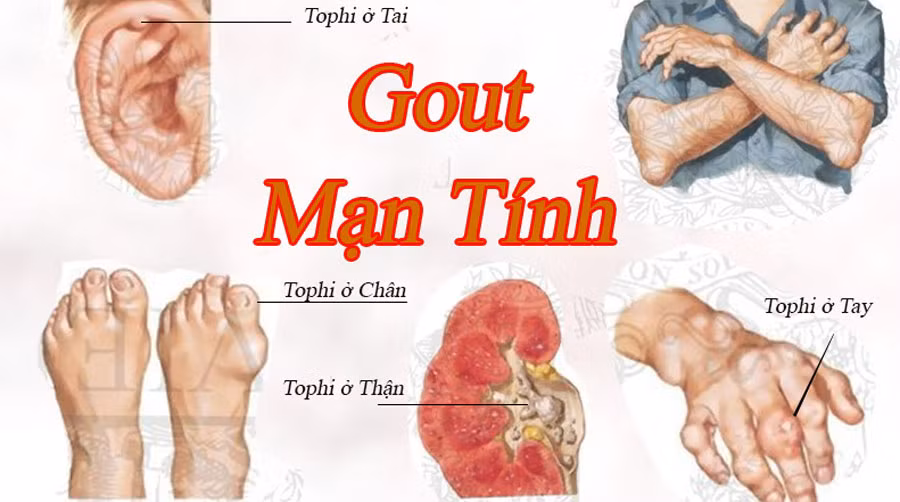Người bị bệnh gout, viêm đau xương khớp: ốc là một trong những loại thực phẩm khắc tinh với những người bệnh này. Nếu không biết mà vô tình ăn quá nhiều ốc bệnh sẽ phát tác và gây đau đớn cho người bệnh nhiều hơn. Ảnh: Infonet. 