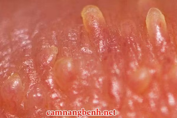 Cận cảnh những nốt sùi mào gà chi chít trên da. Ảnh: Camnangbenh.