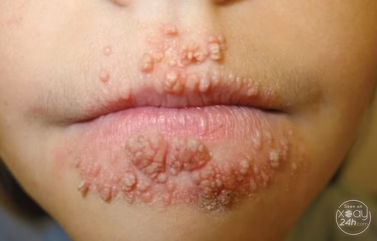 Khi mắc phải căn bệnh này, bệnh nhân có thể gặp phải những triệu chứng khủng khiếp như những hình ảnh và thông tin dưới đây. Ảnh: 24h.