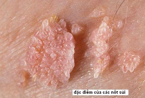 Cận cảnh những nốt sùi trên da thịt nhìn không khác gì như chiếc mào gà. Ảnh: ĐK Baoanh.