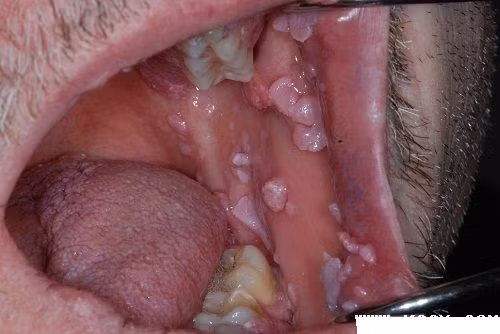 Tuy nó không gây vô sinh nhưng đây là một bệnh mất nhiều thời gian chữa trị, dễ tái phát. Bệnh sùi mào gà thể lây lan nhanh và để lại những dấu hiệu xấu xí trên da thịt. Ảnh: Phukhoa.