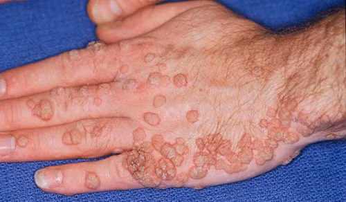 Đây là hình ảnh bàn tay của một bệnh nhân bị sùi mào gà với những nốt mọc chi chít trên da thịt trông rất đáng sợ. Ảnh: Songkhoe.