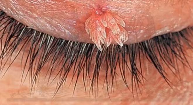 Cận cảnh một nốt sùi mào gà kinh dị mọc trên mi mắt. Ảnh: Heathplus.