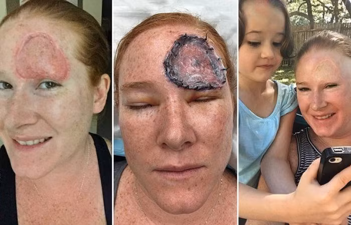 Sau phẫu thuật Bethany Greenway tiếp tục vẫn phải điều trị hóa chất để tiêu diệt hoàn toàn mầm mống tế bào ung thư trong cơ thể. Nguồn ảnh: Dailymail.