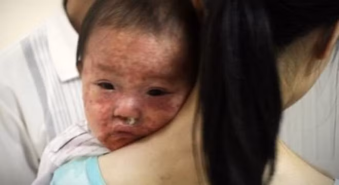 Bệnh sởi: Chắc hẳn các bạn chưa quên tình trạng dịch sởi bùng phát ở nước ta khiến hàng ngàn bệnh nhi nhập viện năm 2015. Ảnh: Heathplus.