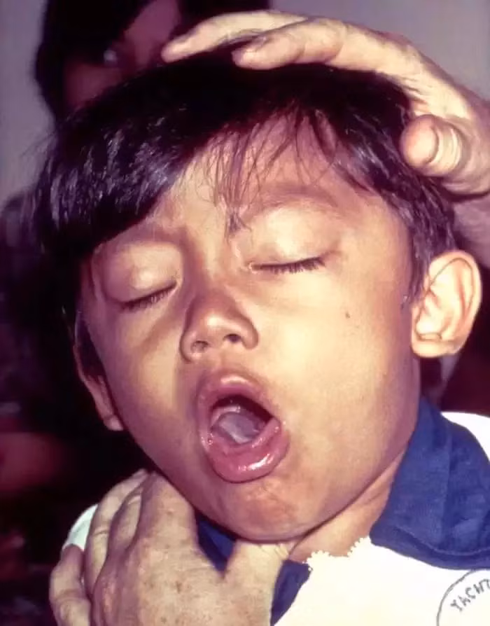 Bệnh ho gà: Đây là căn bệnh từng được phòng rất tốt ở nước ta do trẻ sau sinh được tiêm phòng đầy đủ. Tuy nhiên, gần đây số bệnh nhi mắc ho gà và tử vong vì ho gà có xu hướng ngày càng tăng. Nguyên nhân của tình trạng này là do nhiều bé không được tiêm vacxin phòng bệnh ho gà sau sinh đầy đủ. Ảnh: Yhocthuongthuc.