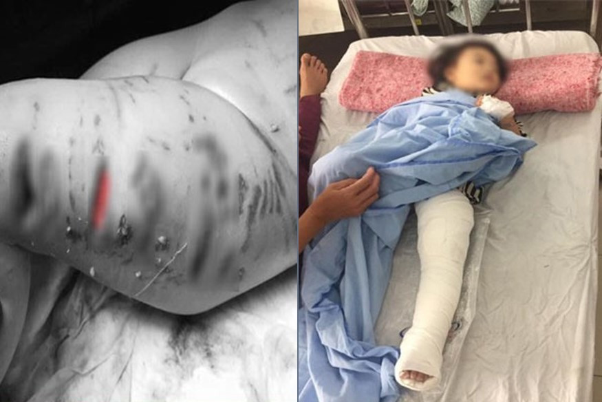  Bé gái 2 tuổi ở Hà Nội thương tích khi bị chó pitbull tấn công. Cuối tháng 3/2019, một bé gái 2 tuổi ở Hà Nội cũng từng bị chó pitbull tấn công khiến bé phải nhập viện với nhiều vết rách trên cơ thể, may mắn bé không bị ảnh hưởng đến tính mạng. 