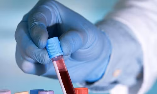 Nghien cuu moi: Nguoi co nhom mau A de mac Covid-19