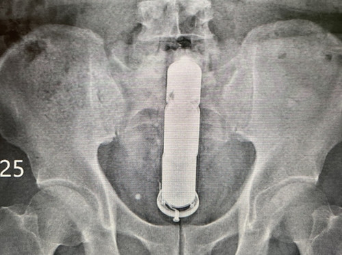 Móc dị vật 30cm trong ruột ra, người đàn ông khiến bác sĩ đỏ mặt Moc di vat 30cm trong ruot ra, nguoi dan ong khien bac si do mat