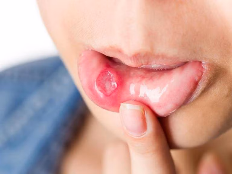 Tê miệng rõ ràng và hạn chế mở miệng: Bình thường, chúng ta có thể đưa ba ngón tay ngang vào giữa răng cửa hàm trên và răng cửa hàm dưới, lúc này miệng khoảng 5 cm. Nếu chỉ đưa được hai ngón tay vào là lâm sàng nhẹ, hạn chế nếu chỉ đưa một ngón tay vào miệng, miệng bị hạn chế đóng mở thì bạn phải rất lưu ý.