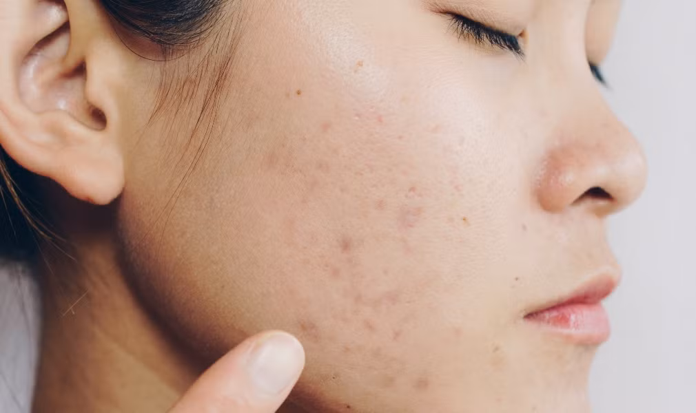 Thứ ba là da mặt xanh xao, thiếu sức sống. Thực tế, làn da sẽ xấu đi trông thấy, trở nên nhợt nhạt, tái xanh và trông thiếu sức sống rõ ràng khi chức năng của gan suy giảm.