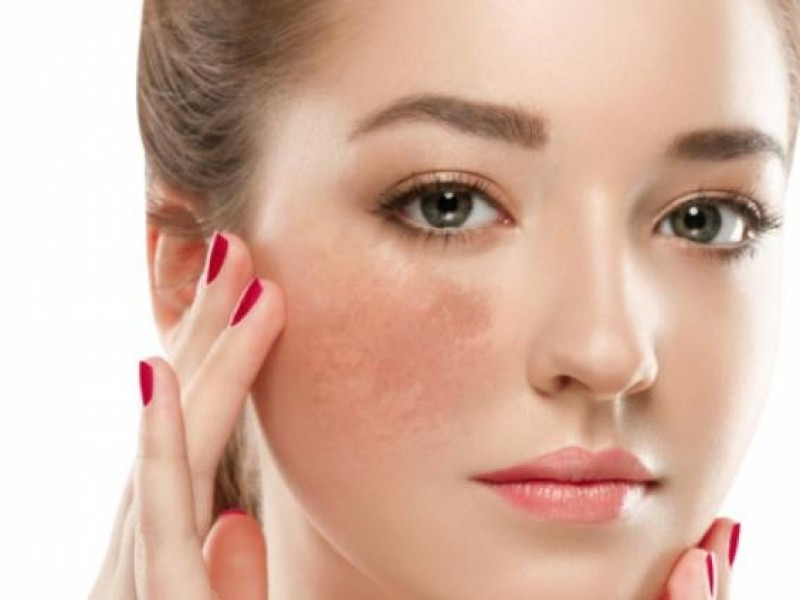 Thứ hai là sạm da vùng gò má. Theo các chuyên gia sức khỏe, khi tuyến thượng thận bị tổn thương, các hắc tố trên da được sản sinh nhiều và giải phóng khỏi lớp tế bào đáy, ứ đọng ở phần trên của trung bì, điều này da chuyển sang màu vàng rồi thành nâu sạm lại.