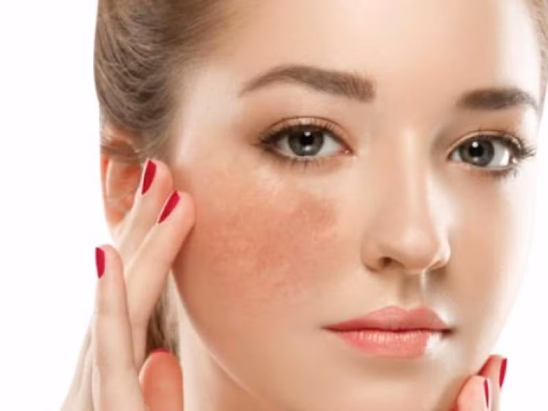 Thứ hai là sạm da vùng gò má. Theo các chuyên gia sức khỏe, khi tuyến thượng thận bị tổn thương, các hắc tố trên da được sản sinh nhiều và giải phóng khỏi lớp tế bào đáy, ứ đọng ở phần trên của trung bì, điều này da chuyển sang màu vàng rồi thành nâu sạm lại.