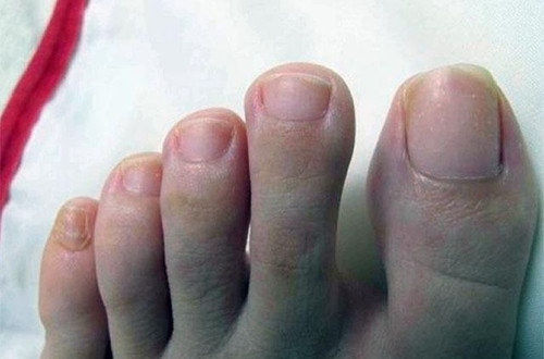 Nhin chan co 4 dau hieu nay, ung thu than da tim den ban