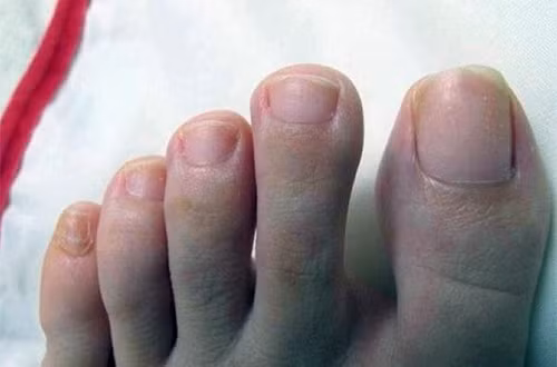 Nhin chan co 4 dau hieu nay, ung thu than da tim den ban