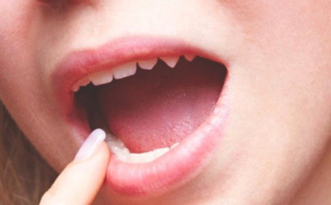 Thứ năm, chống ung thư. Nhà khoa học Nhật Bản, Giáo sư Nishi Monday cho hay nước bọt là chất có tác dụng chống ung thư, có thể biến đổi chất gây ung thư thành vô hại. Khi bạn nhai chậm thức ăn, nước bọt được trộn đều, có thể giảm sự xuất hiện của ung thư thực quản, ung thư dạ dày, ung thư đại trực tràng...