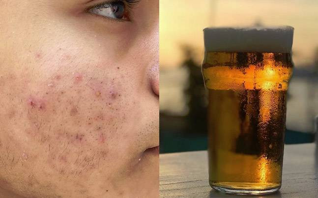 Đồng thời, chuyên gia này cũng cho biết, bia có tính axit, độ pH từ 4 đến 5. Chất axit vốn không tốt cho da, dù nồng độ cồn trong bia chỉ 5% nhưng nếu tiếp xúc với da tần suất thường xuyên và thời gian dài, da có thể bị mất nước và khô, thậm chí viêm nhiễm, nhiều tác hại khôn lường.