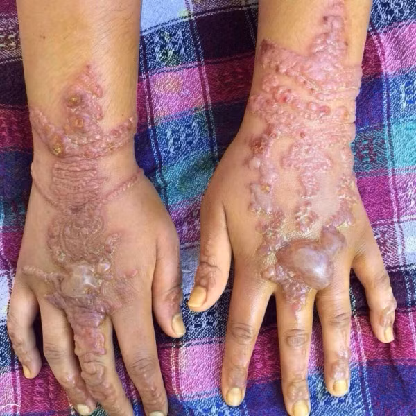 Co gai tre bi bong hoa hoc, mang seo ca doi vi xam hinh Henna-Hinh-3