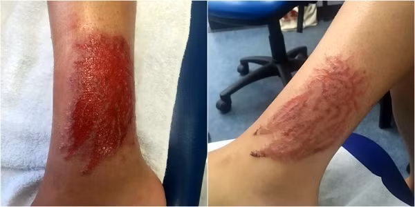 Co gai tre bi bong hoa hoc, mang seo ca doi vi xam hinh Henna-Hinh-2