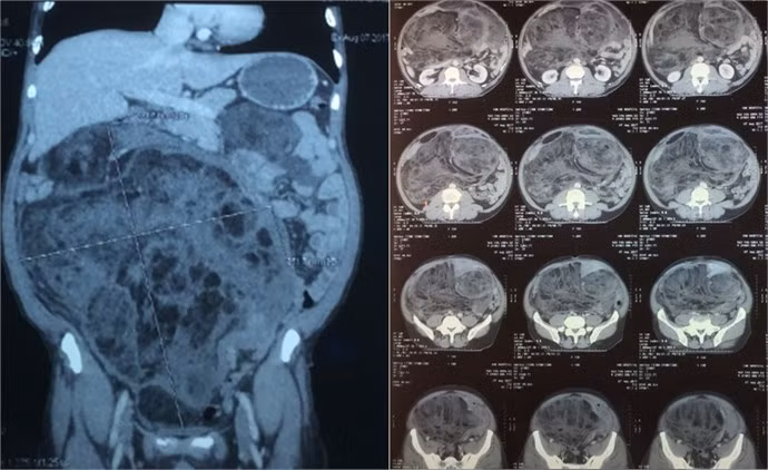 Cat bo khoi u khung chiem tron o bung cung nua dai trang phai