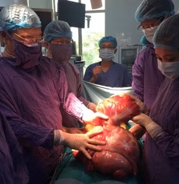 Cat bo khoi u khung chiem tron o bung cung nua dai trang phai-Hinh-2