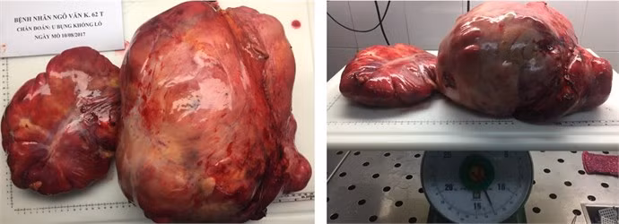 Cat bo khoi u khung chiem tron o bung cung nua dai trang phai-Hinh-3