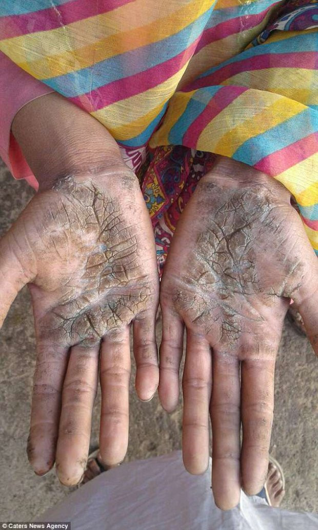 Ngay cả bàn tay cũng bị “hóa đá”.