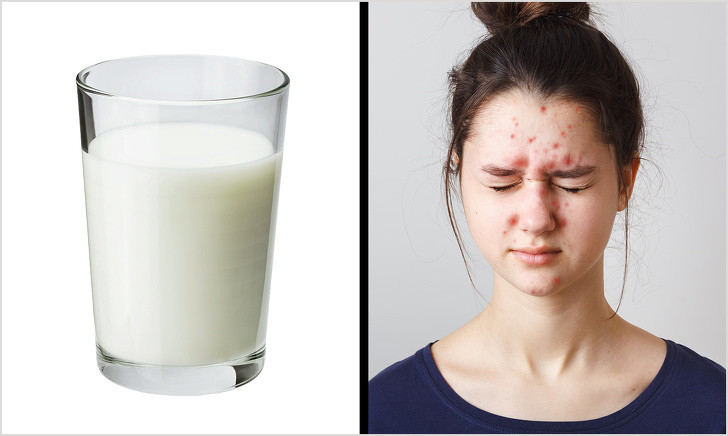 Sữa bò và các sản phẩm từ sữa khiến da nổi mụn: Nếu bạn từng có mụn trứng cá hoặc viêm da khi uống sữa bò thì hãy kiểm tra dị ứng. Nếu bạn bạn không bị dị ứng, hãy cố gắng giảm lượng sữa và ăn nhiều thực phẩm giàu i-ốt hơn như hải sản và dầu cá để chống lại quá trình viêm.