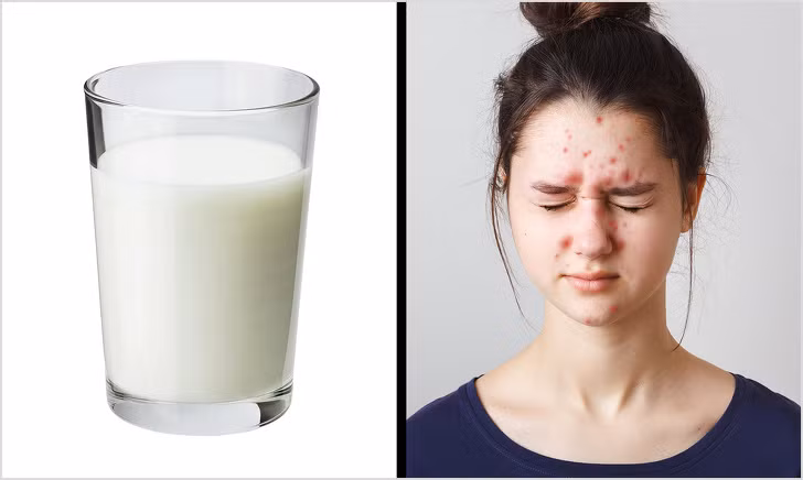 Sữa bò và các sản phẩm từ sữa khiến da nổi mụn: Nếu bạn từng có mụn trứng cá hoặc viêm da khi uống sữa bò thì hãy kiểm tra dị ứng. Nếu bạn bạn không bị dị ứng, hãy cố gắng giảm lượng sữa và ăn nhiều thực phẩm giàu i-ốt hơn như hải sản và dầu cá để chống lại quá trình viêm.