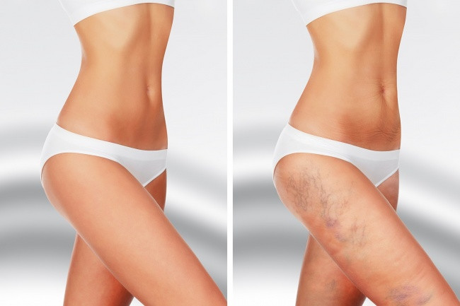 Các thay đổi liên quan đến tuổi tác: Hệ thống mạch máu yếu đi theo độ tuổi và các mô bị mất tính đàn hồi của chúng. Bạn nên chú ý rằng những vết bầm do tuổi tác chủ yếu xuất hiện ở chân.