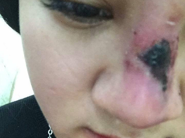 Nạn nhân tố "nữ bác sĩ" phẫu thuật làm lòi xương mũi.