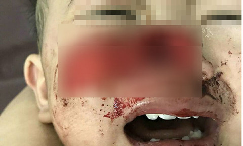 Cùng thời điểm này, bé Lê Nguyễn Tường Nguyên (3 tuổi, ngụ Đắk Lắk) cũng nhập viện trong tình trạng chó nhà cắn mất một phần cánh mũi, phần mũi và miệng dập nát.