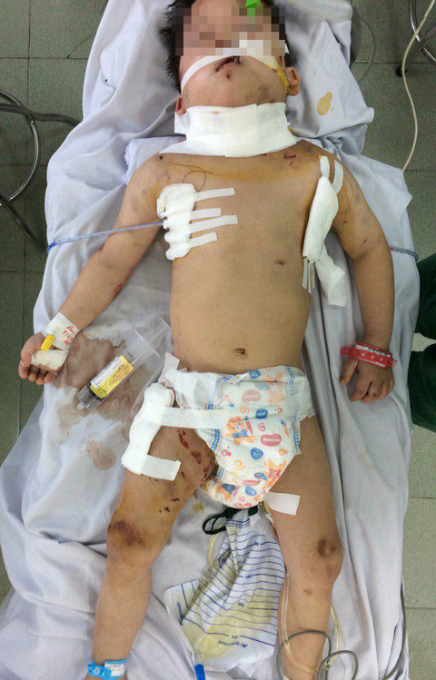 Đầu năm nay, Bệnh viện Nhi Đồng 1 (TP.HCM cũng cấp cứu cho hai bé trai bị chó nhà cắn. Trong đó, có một bé trai tên N.T.Đ. (5 tuổi, ở Long Thành, Đồng Nai) bị hai con chó béc-giê cắn. Hai con chó đã cắn xé khiến bé Đ. bị thủng khí quản. Khí đã tràn xuống dưới đùi. Các khoang trong bụng bị khí tràn vào hết, tình trạng rất nguy kịch.