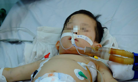 Ngay lập tức bé được chuyển vào phòng mổ cấp cứu. Ê-kíp bác sĩ phát hiện có 1 lỗ thủng ở vùng cổ. Đây chính là nguyên nhân khiến khí tràn khắp cơ thể bệnh nhi. Các bác sĩ đã tiến hành khâu lại vết hở.